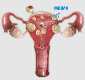 Mioma, Dra Bianca Bocchi