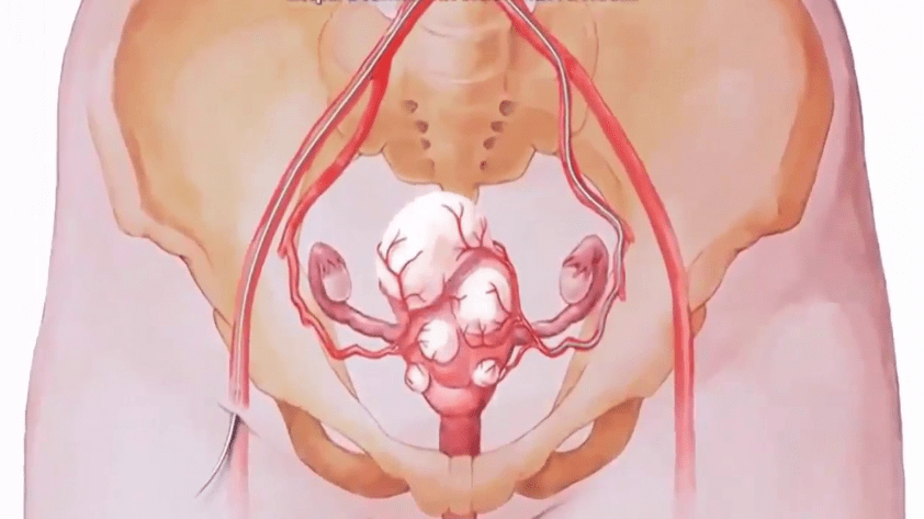 pelve feminina com miomas