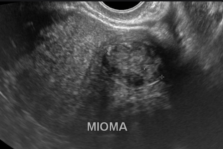 Mioma em ultrassom
