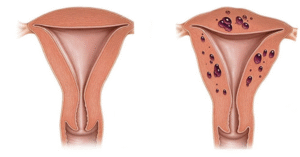 Dra Bianca Bocchi adenomiose