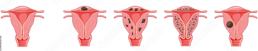 adenomiose focal
adenomiose difusa
adenomioma