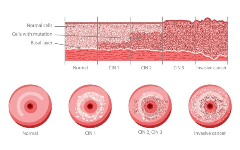 NIC 1 / NIC 2 / NIC 3 / COLO DO ÚTERO / CÂNCER INVASOR CERVICAL
