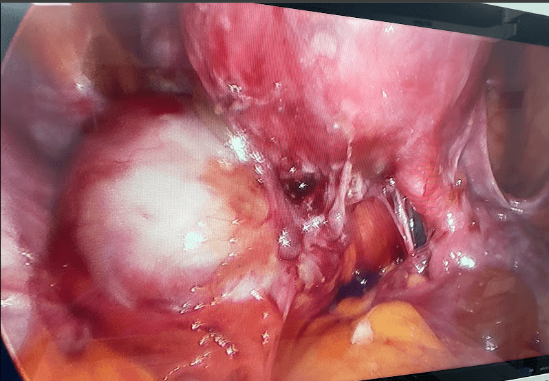 laparoscopia de endometriose profunda e endometrioma ovário - Dra Bianca Bocchi