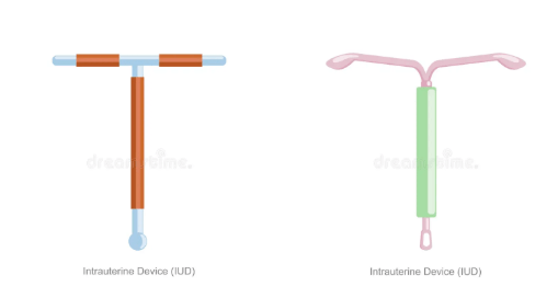 DIU COBRE E DIU HORMONAL MIRENA KYLEENA
